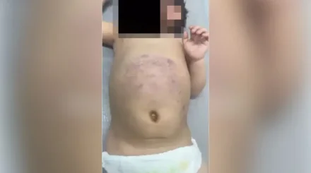 Жетісуда әкесі аяусыз ұрған үш жасар бүлдіршін хирургиялық бөлімде жатыр