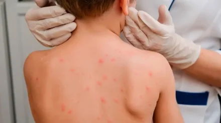 БҚО-да баладан қызылшаның өлімге әкелуі мүмкін қауіпті асқынуы анықталды