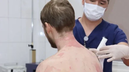 В Алматы врачи спасли мужчину с ожогами 89% тела после взрыва газового баллона