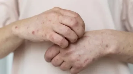 Елде мерез қайта көбейді: қай өңірлерде жағдай күрделі?