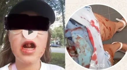 Жақ сүйегі сынып, екі тісі түсіп қалған: Қызды қағып, қашып кеткен электровелосипед жүргізушісі ұсталды