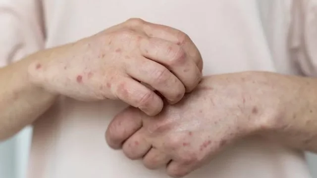 Елде мерез қайта көбейді: қай өңірлерде жағдай күрделі?
