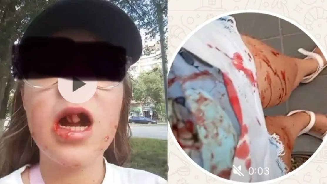Жақ сүйегі сынып, екі тісі түсіп қалған: Қызды қағып, қашып кеткен электровелосипед жүргізушісі ұсталды