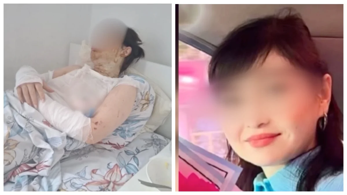 Шымкент тұрғынына бұрынғы күйеуі қышқылмен бетін күйдіріп тастаған